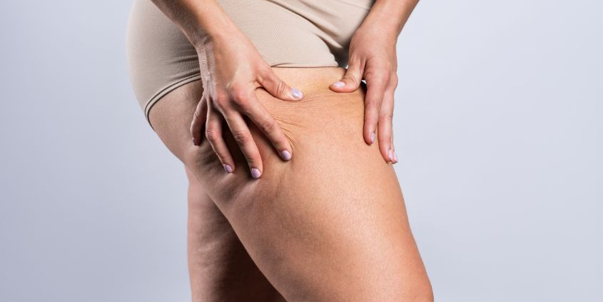Lipödem Behandlung durch Lymphdrainage: Wirkungsweise und Vorteile